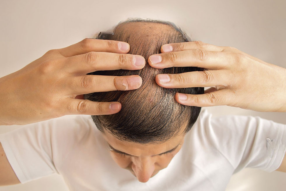 Los mejores tratamientos contra la caída del cabello